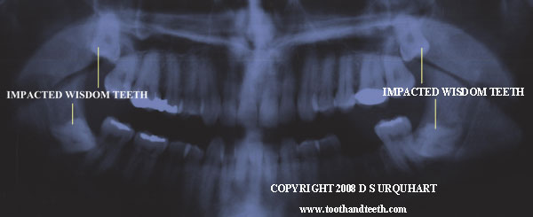 Completely impacted wisdom teeth can potentially develop into a cyst, 